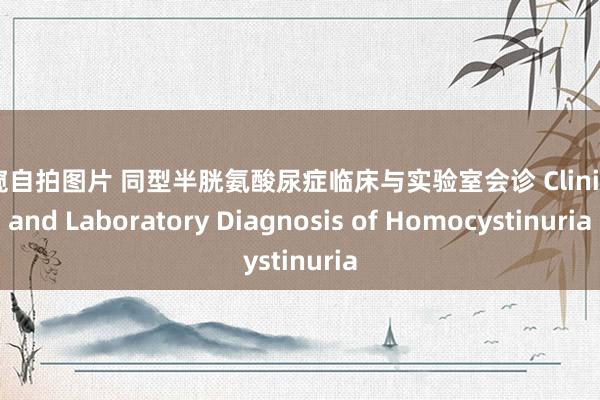 偷窥自拍图片 同型半胱氨酸尿症临床与实验室会诊 Clinical and Laboratory Diagnosis of Homocystinuria